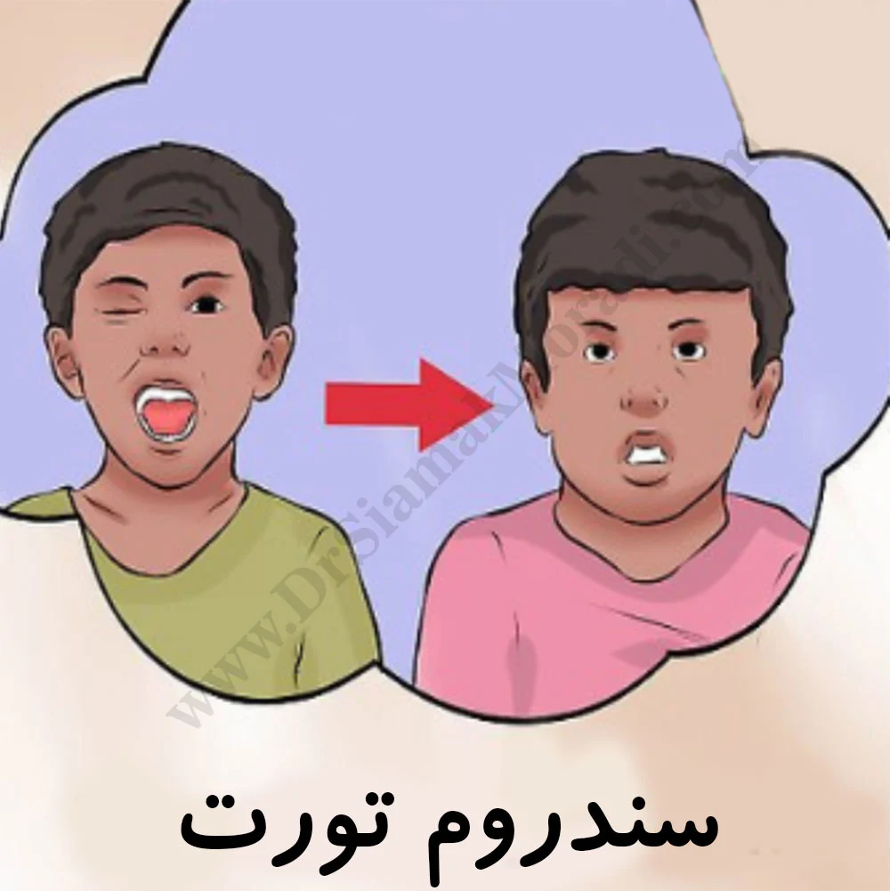 سندروم