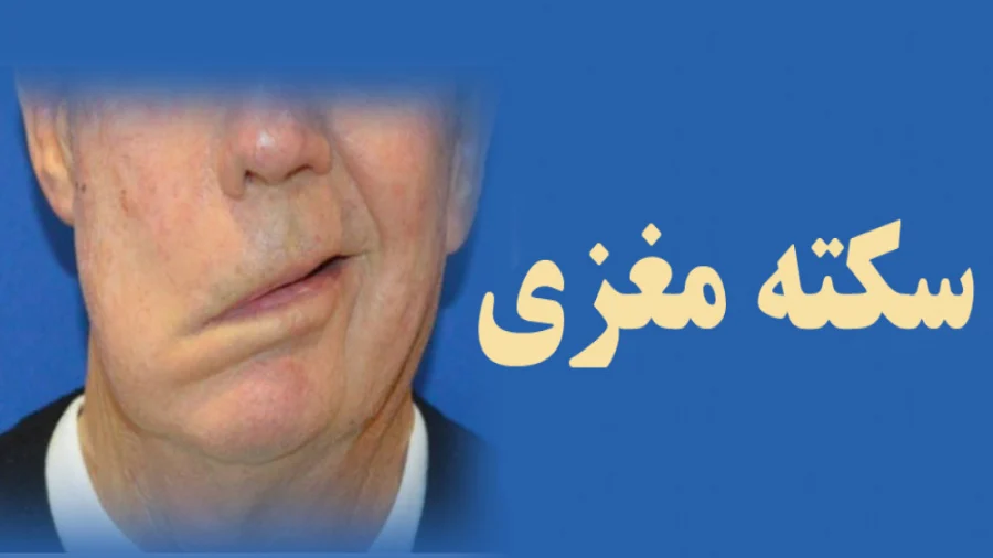 سکته مغزی
