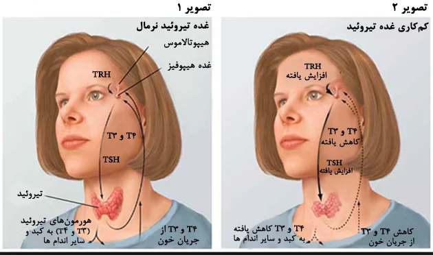 تیروئید