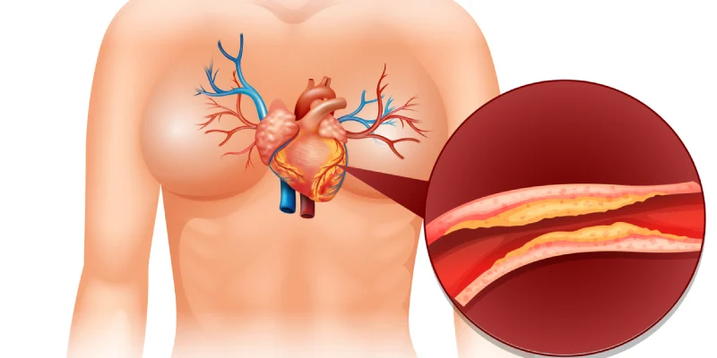 چربی خون چربی خون