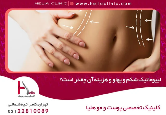 لیپوماتیک لیپوماتیک