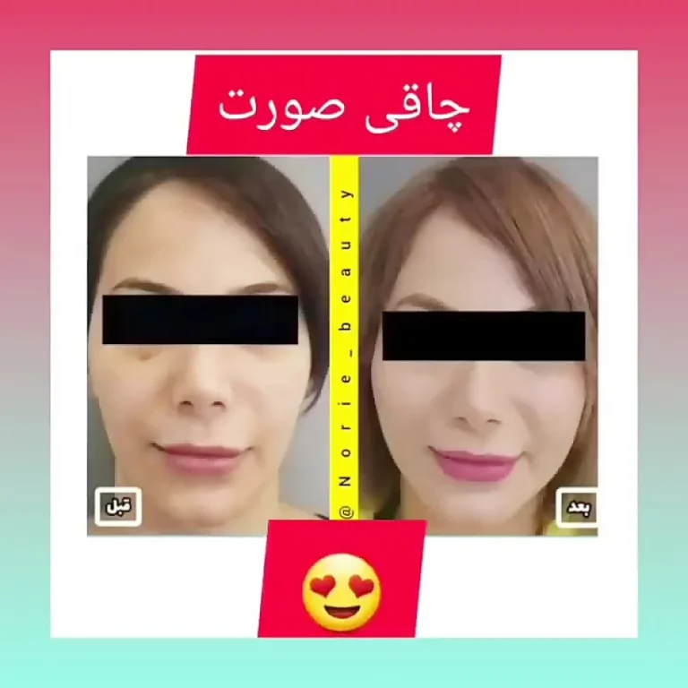چاقی صورت با سیب زمینی و گلاب