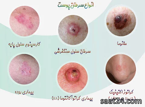 پوست