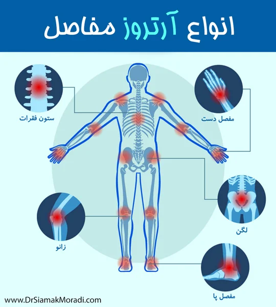 آرتروز