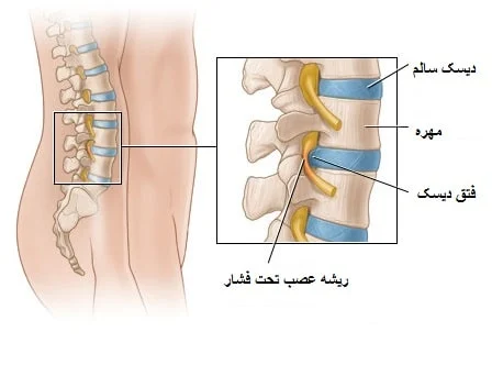 دیسک کمر