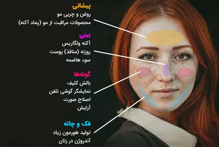 جوش صورت جوش صورت