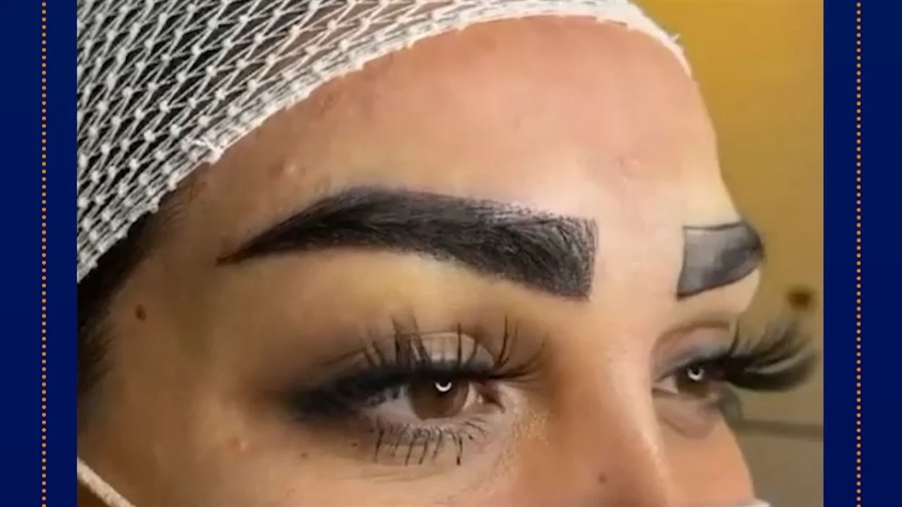 کاشت ابرو