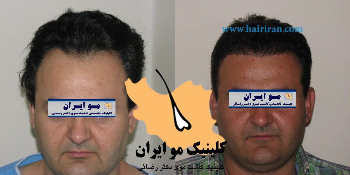 کاشت مو